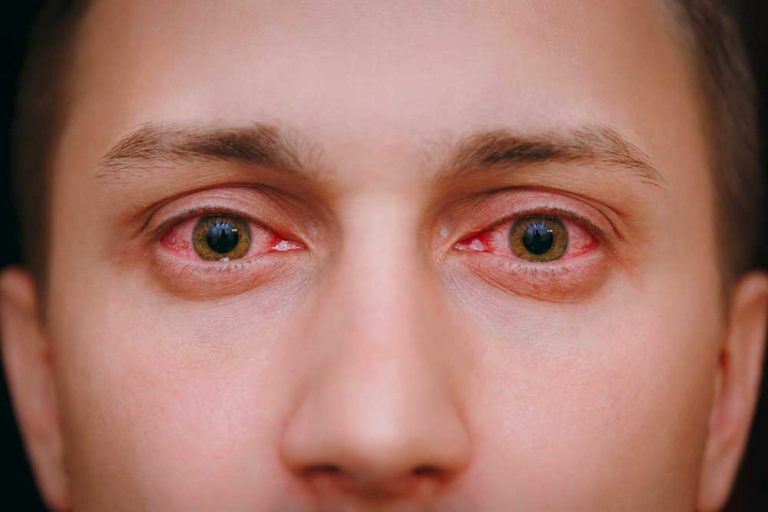 Comment Enlever Les Yeux Rouges Les Remèdes Efficaces Medias Du Sud